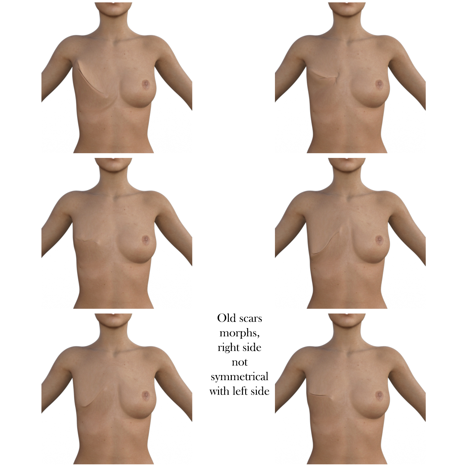 Amazons Mastectomy for G8F and G8.1 F by N/A