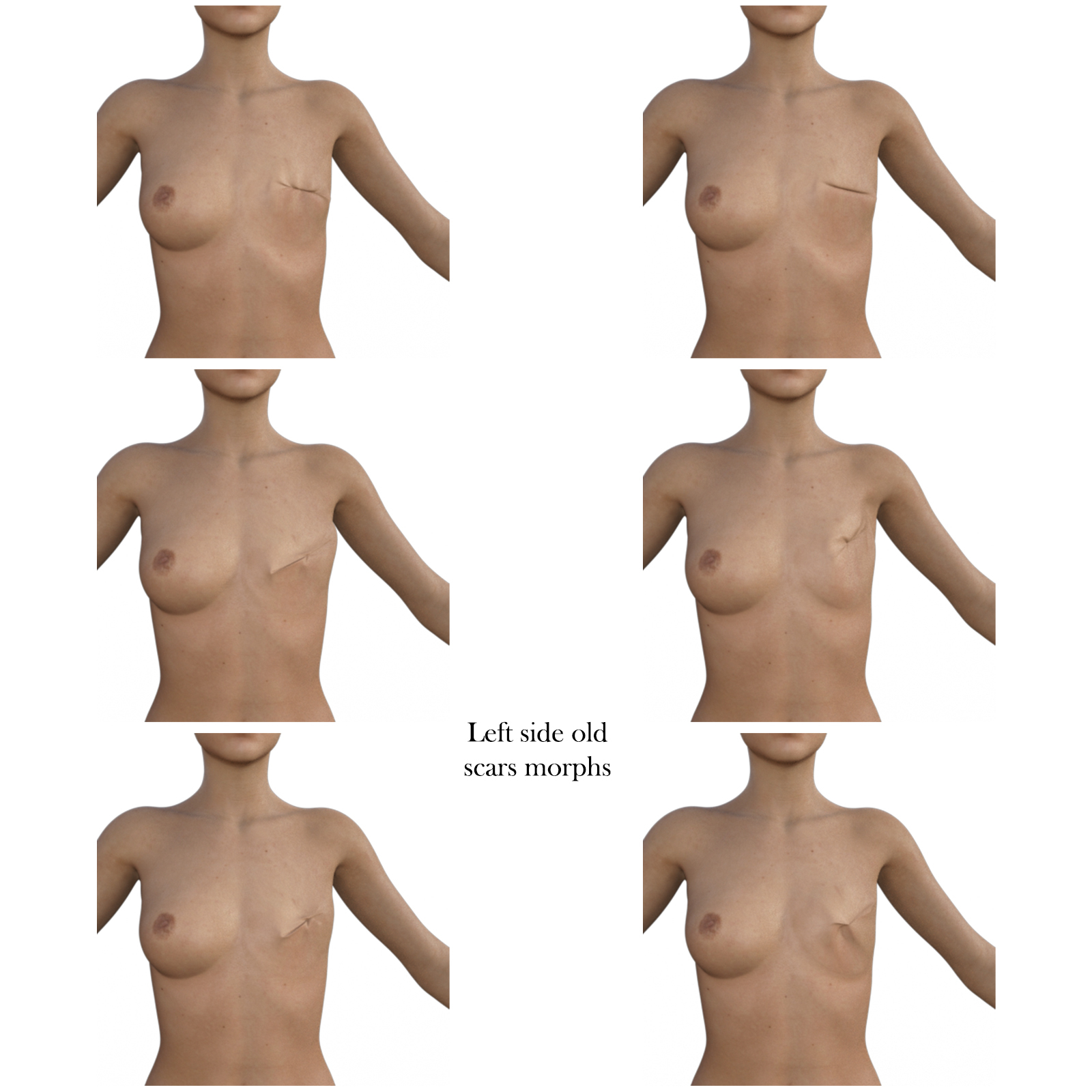 Amazons Mastectomy for G8F and G8.1 F by N/A